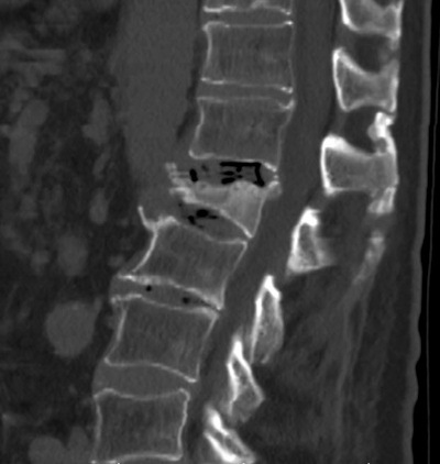 DEXA results were normal in a patient with an L1 compression fracture and osteoporosis at CT