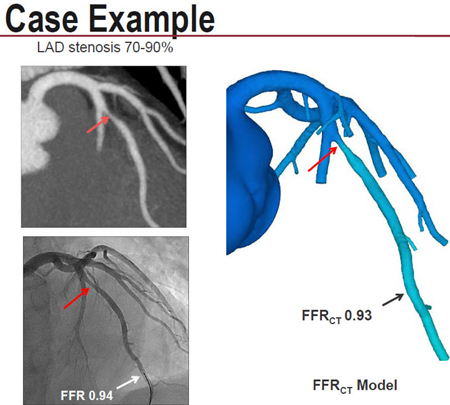 FFR-CT case example