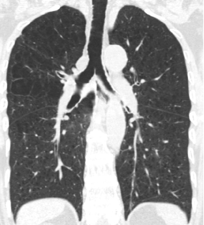 CT of emphysema
