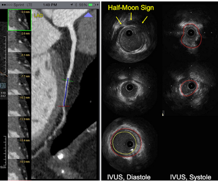 CT and IVUS for myocardial bridges