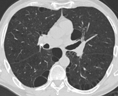 Patient with paraseptal emphysema