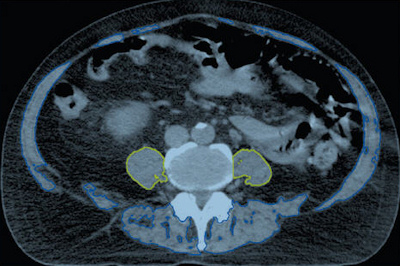 Axial CT images obtained in a 71-year-old man