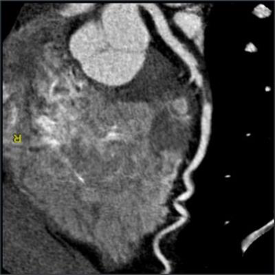 CCTA scan indicates severe stenosis in the left anterior descending artery