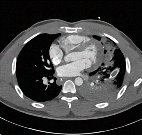 CT scan reveals a bullet fragment in the left ventricular wall