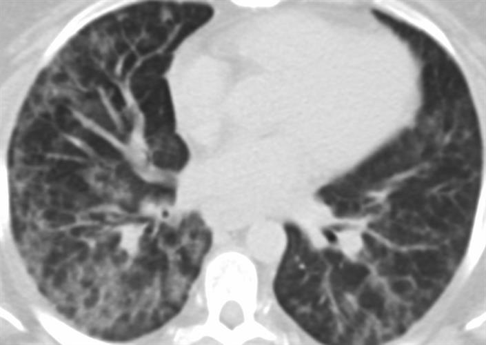 Axial CT image shows relatively symmetric ground-glass opacity and perilobular opacities involving all lobes