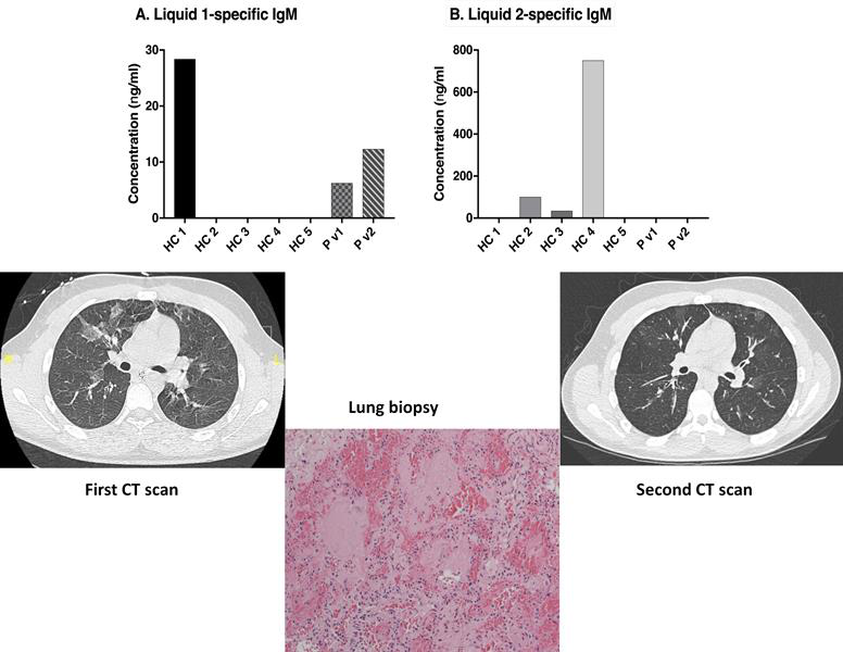 Radiology-immunology-histopathology correlation in a case of hypersensitivity pneumonitis