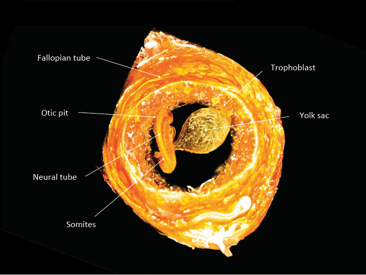 An intact ectopic pregnancy in the fallopian tube