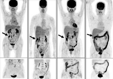 cancer colon pet scan)