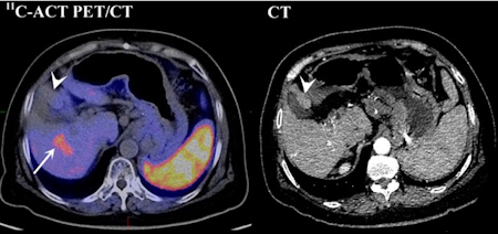 Contrast-enhanced CT and C-11 acetate PET/CT