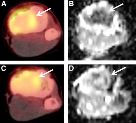 PET/CT and MR of osteosarcoma
