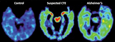 FDDNP-PET images of normal brain scan, patient with suspected CTE, and Alzheimer