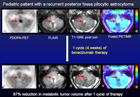 Dynamic FDOPA-PET and multiplanar pre- and postcontrast MR images