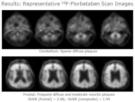 Florbetaben-PET of amyloid plaque