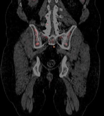 PET scan with Axumin