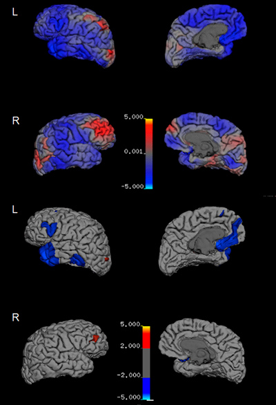 Percentage change in cortical thickness