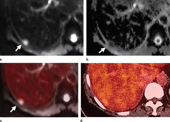 Axial PET/MRI and PET/CT images are from a 64-year-old woman with a history of left breast cancer metastatic to lung and bone