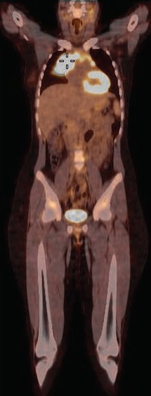 FDG-PET/CT of a 15-year-old girl with a mediastinal mass