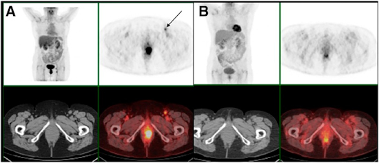 FDG-PET/CT images show an anal tumor