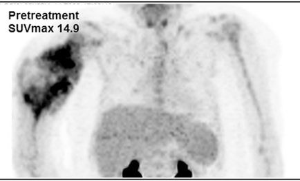 8-year-old with osteosarcoma at baseline