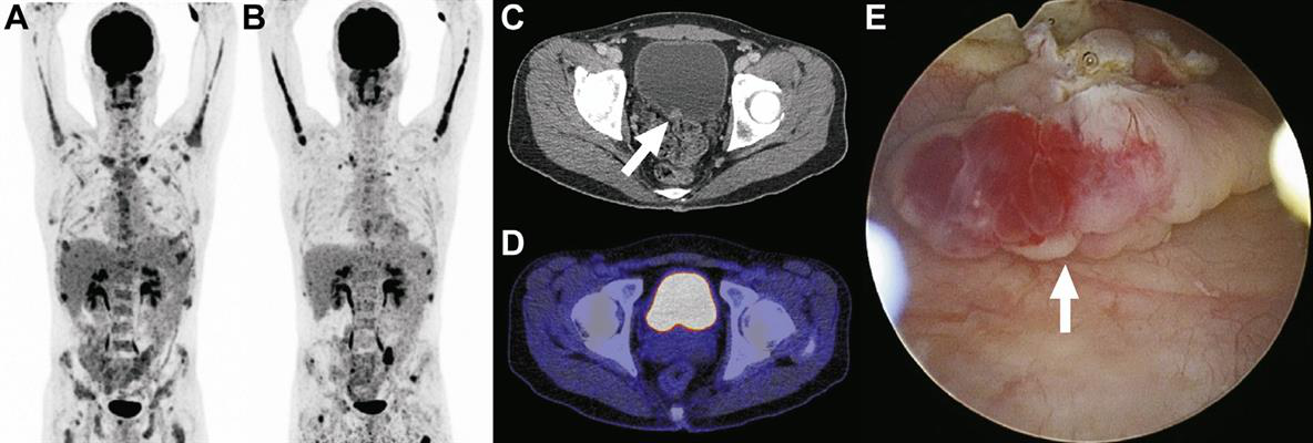 40-year-old man with plasmablastic lymphoma and multiple bone lesions