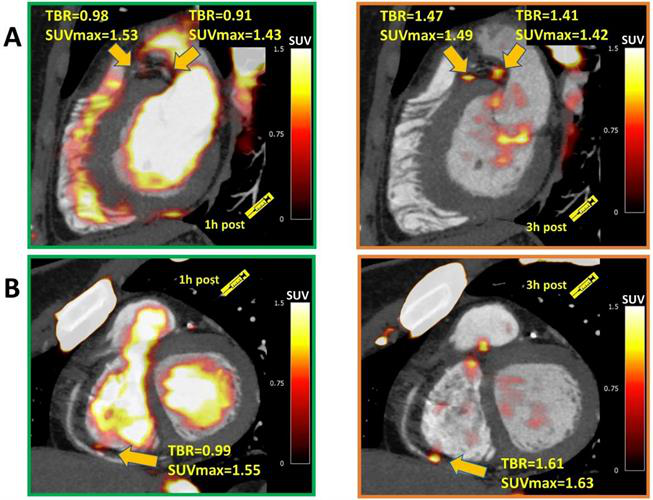 Images show significant NaF uptake in proximal left anterior descending, proximal circumflex, and distal right coronary artery plaques