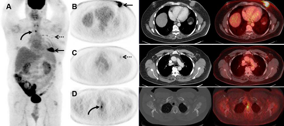 Images are from a 53-year-old man with stage IIB breast cancer that was upstaged to stage IV by FDG-PET/CT