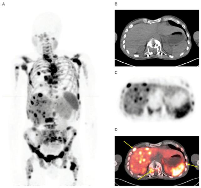 Images with Cu-64 DOATATE PET/CT from a patient with metastatic bronchial carcinoid and extensive metastatic disease