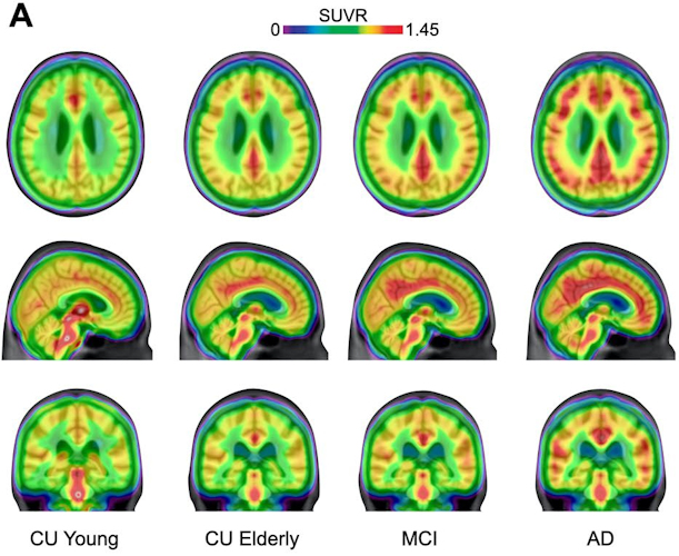 Averaged carbon-11 PBR28 standardized uptake value ratio (SUVR) maps, overlaid on a structural MRI template, suggest a progressively higher uptake in typical Alzheimer