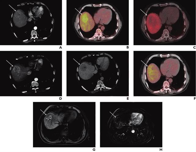 A 74-year-old man with known liver cirrhosis. The patient underwent multiphase contrast-enhanced CT.