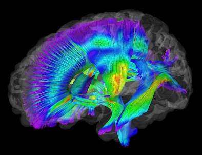 White-matter pathways extracted from DTI-MRI for infants at risk of developing autism.
