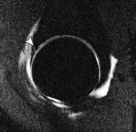 MR arthrography shows anterior acetabular labrum tear
