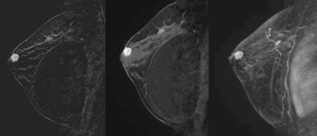 MRI of breast implant patient