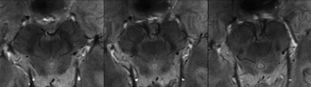 7-tesla MRI of sustantia nigra