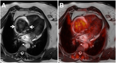 PET/MRI of cardiac tumor