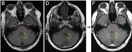 MRI with gadolinium contrast