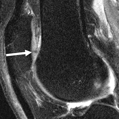 MRI of knee shows signal abnormalities