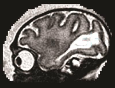 Sagittal MRI of fetal brain of pigtail macaque