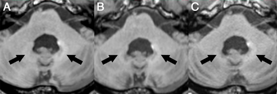 Axial MRI of patient receiving GBCAs