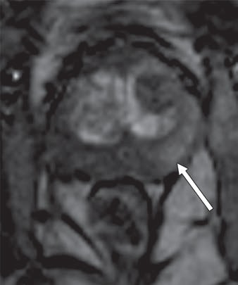 Follow-up MRI two years later better details area of hypointense signal