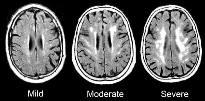 MRI scans show damage to the brain