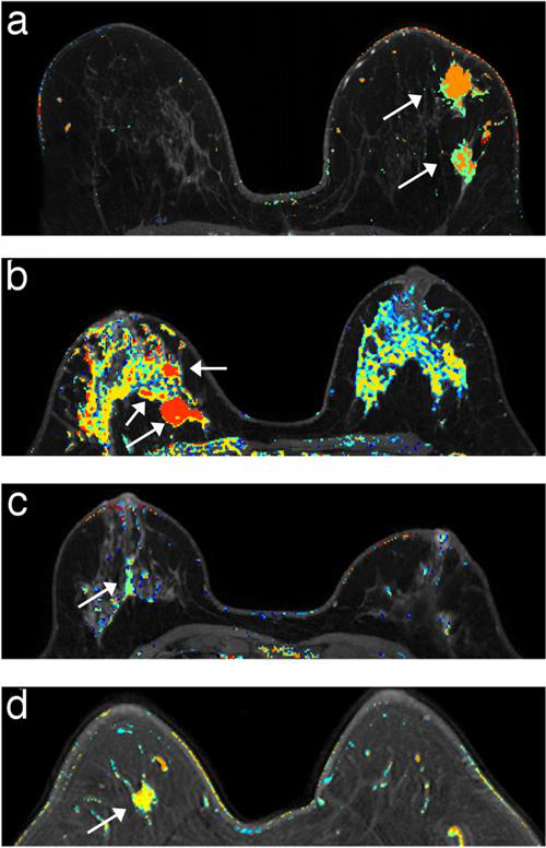 DCE-MRI every six months performed well for the early detection of invasive breast cancer
