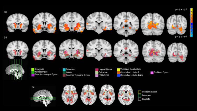 MRI shows brain regions with significantly greater gray-matter volume in 14-year-old subjects who reported one or two instances of cannabis use