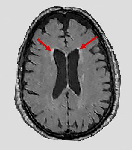 Brain MRI scan showing white-matter lesions