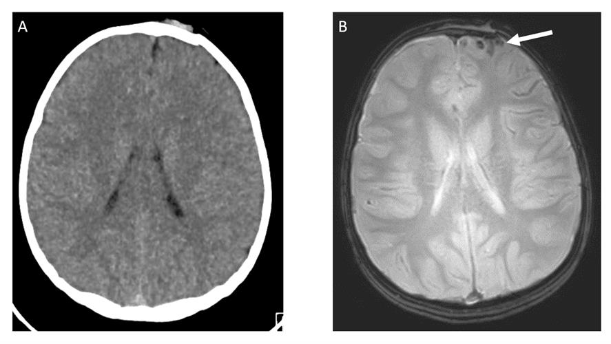 Axial nonenhanced CT and axial T2-weighted GRE MR of the head