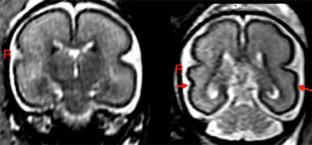 Left: Fetal brain post-intrauterine alcohol exposure in a fetus between 25 and 29 gestational weeks. Note the smooth cortex in the frontoparietal and temporal lobes. Right: Brain of matched healthy control case in a fetus between 25 and 28 gestational weeks. The superior temporal sulcus is already bilaterally formed (red arrows) and appears deeper on the right hemisphere than on the left.