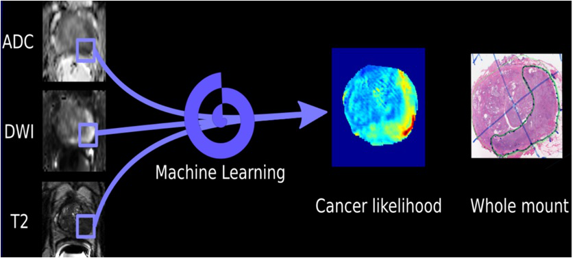 Schematic of machine-learning algorithm for detecting prostate cancer on multiparametric MRI