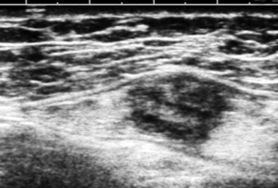 A breast cancer not suspected in screening mammography or physical exam in a woman referred for chest-wall pain