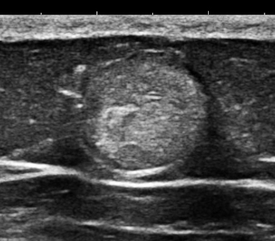 Solid mass of mixed histology at ultrasound