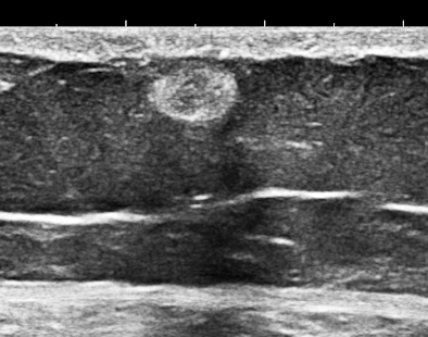 Ultrasound of abdominal wall