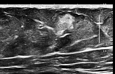 Ultrasound of anterior abdominal wall